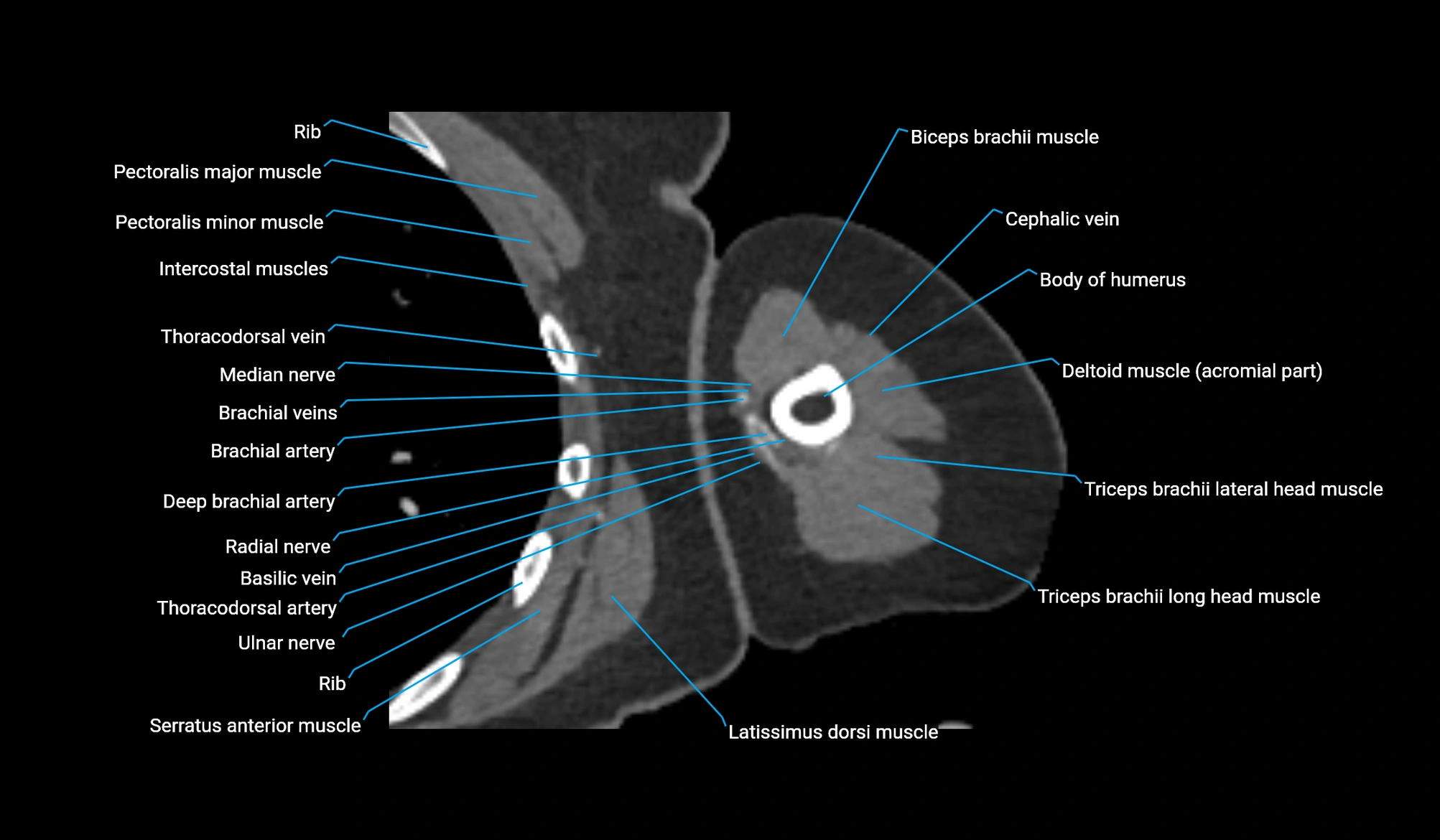 CT upper arm axial  cross sectional anatomy labelled radiology image -00190.webp